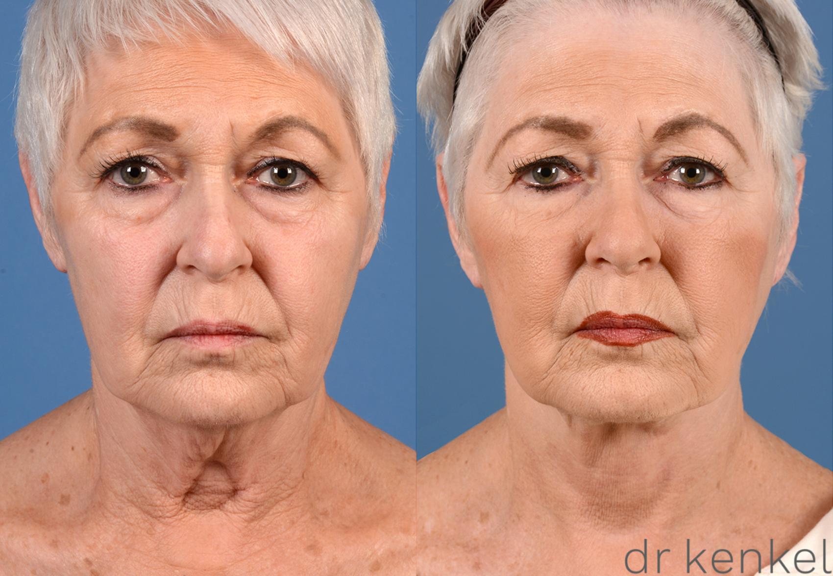 Before & After Facelift Case 253 View #2 View in Dallas, TX