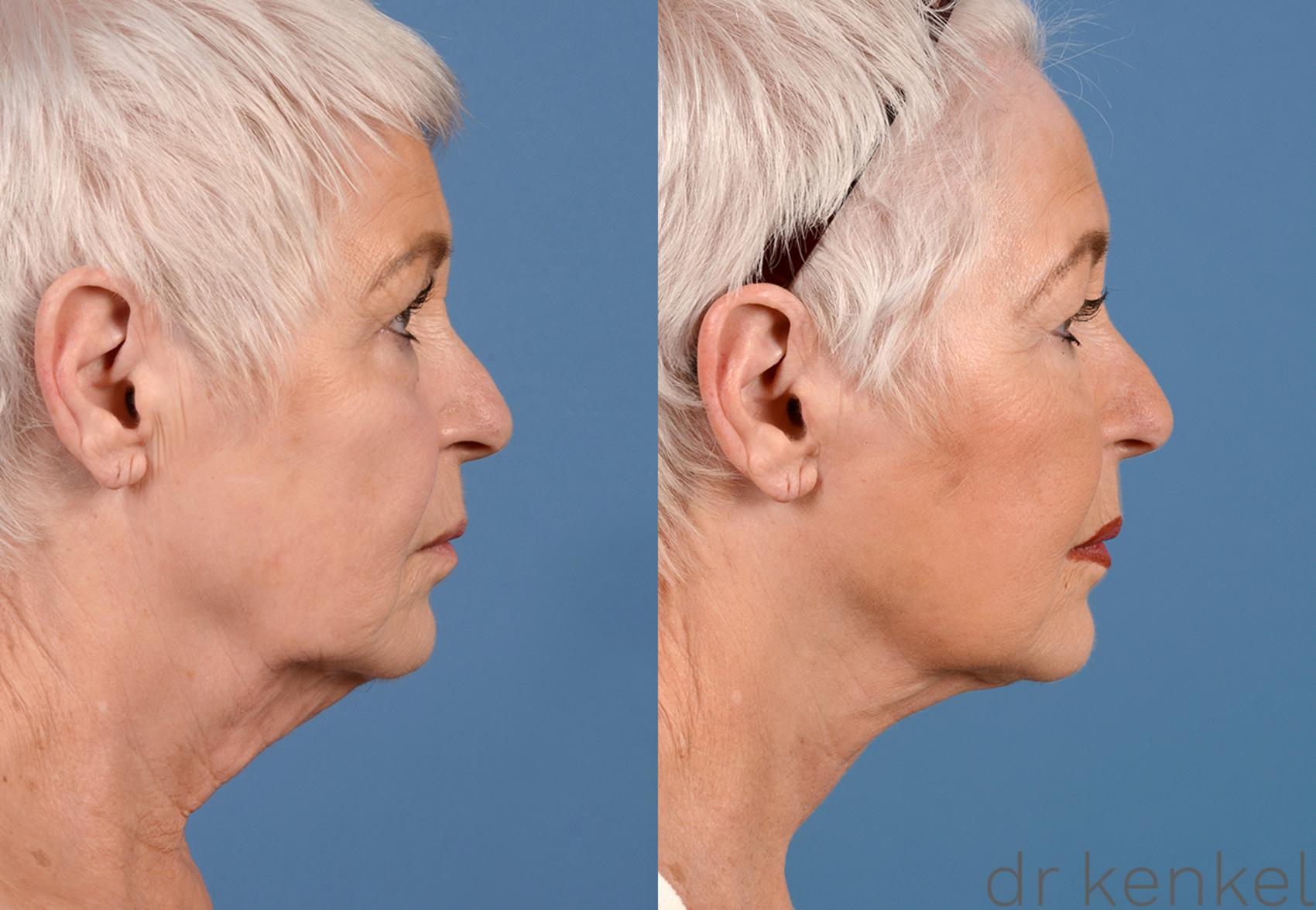 Before & After Facelift Case 253 View #3 View in Dallas, TX
