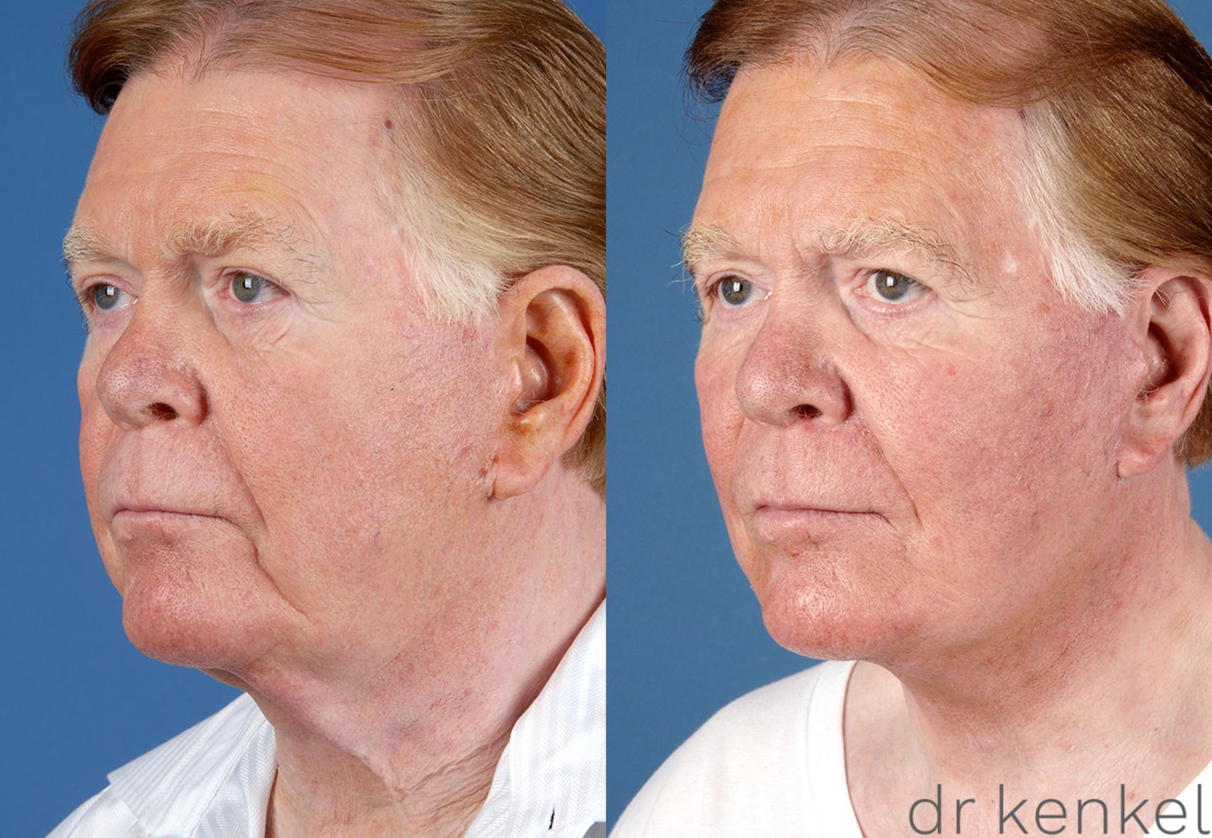 Before & After Facelift Case 255 View #1 View in Dallas, TX