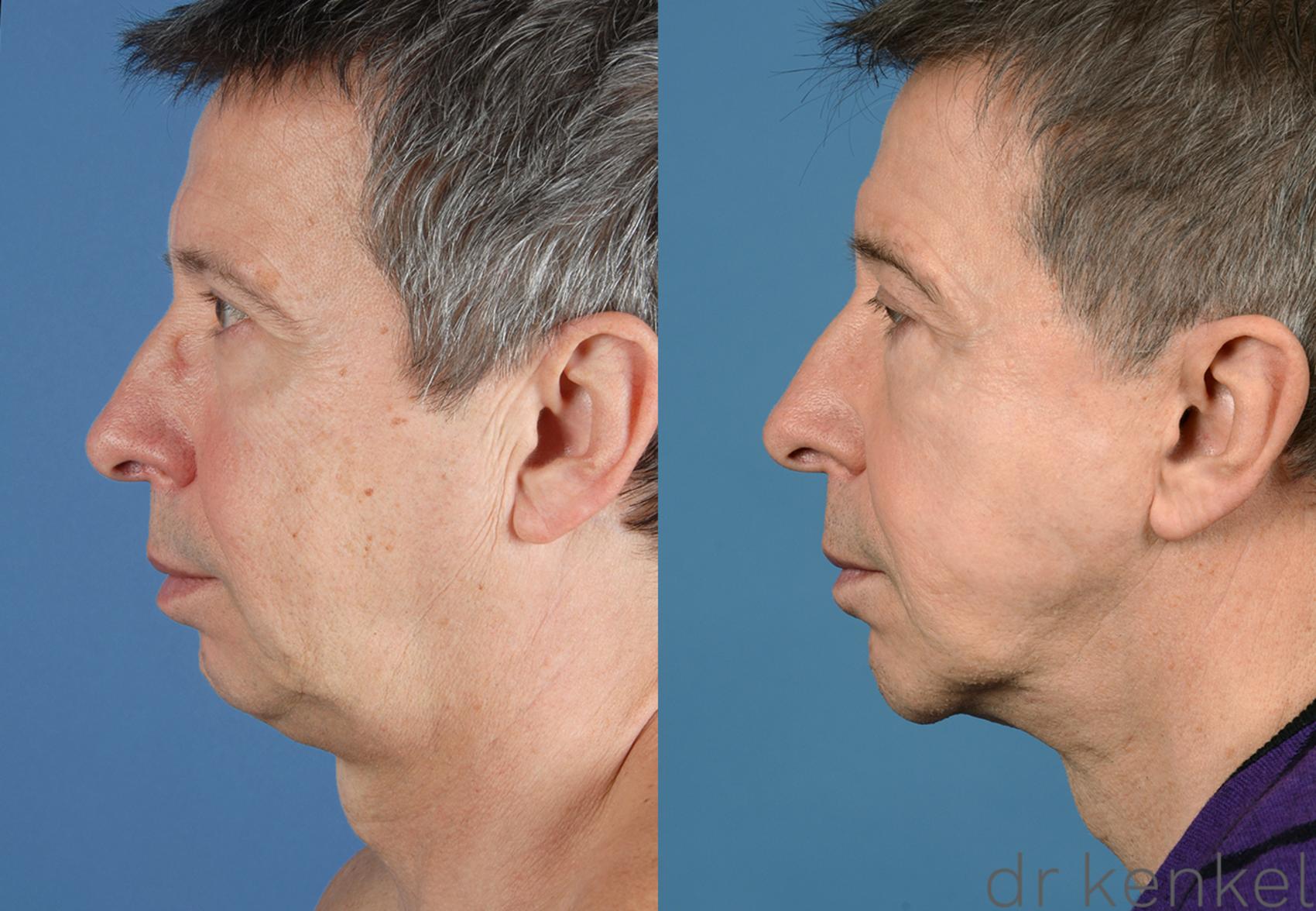 Before & After Facelift Case 257 View #3 View in Dallas, TX