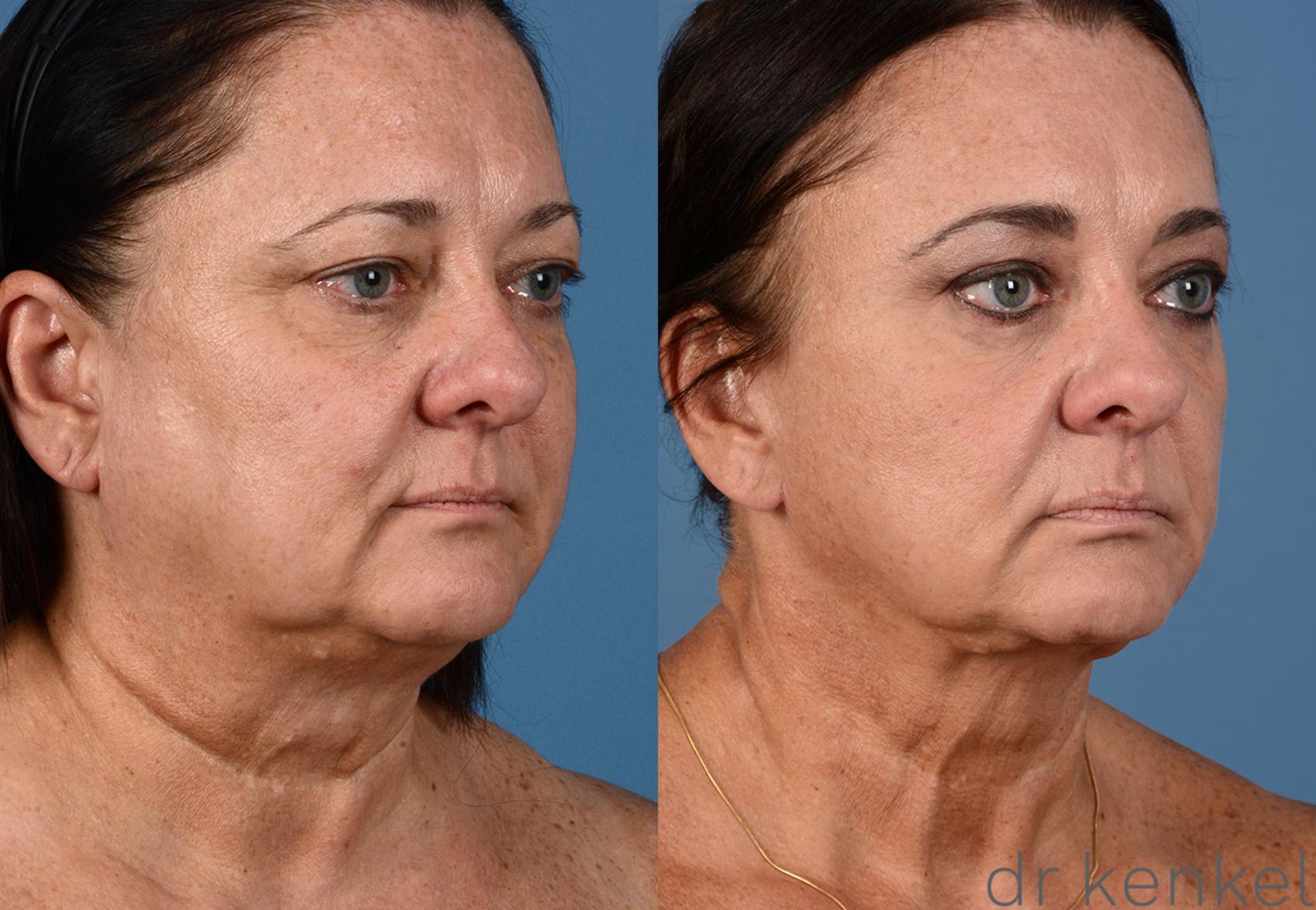 Before & After Eyelid Surgery Case 261 View #1 View in Dallas, Frisco, McKinney, Prosper, Allen, Celina, Denton, Anna, TX