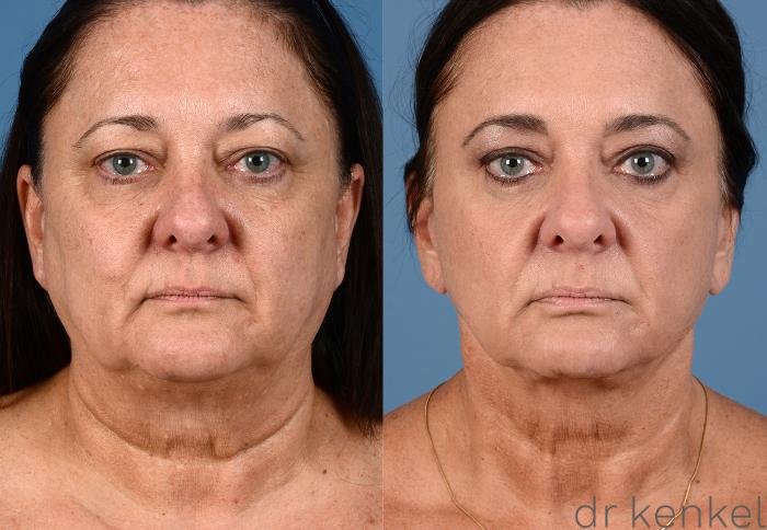 Before & After Eyelid Surgery Case 261 View #2 View in Dallas, Frisco, Fort Worth, McKinney, Prosper, Allen, Celina, Denton, Anna, TX