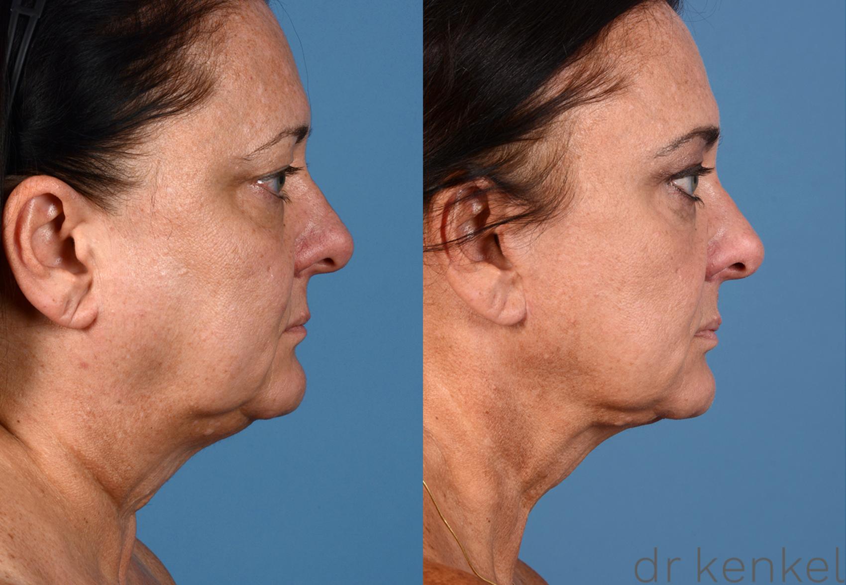 Before & After Facelift Case 261 View #3 View in Dallas, TX