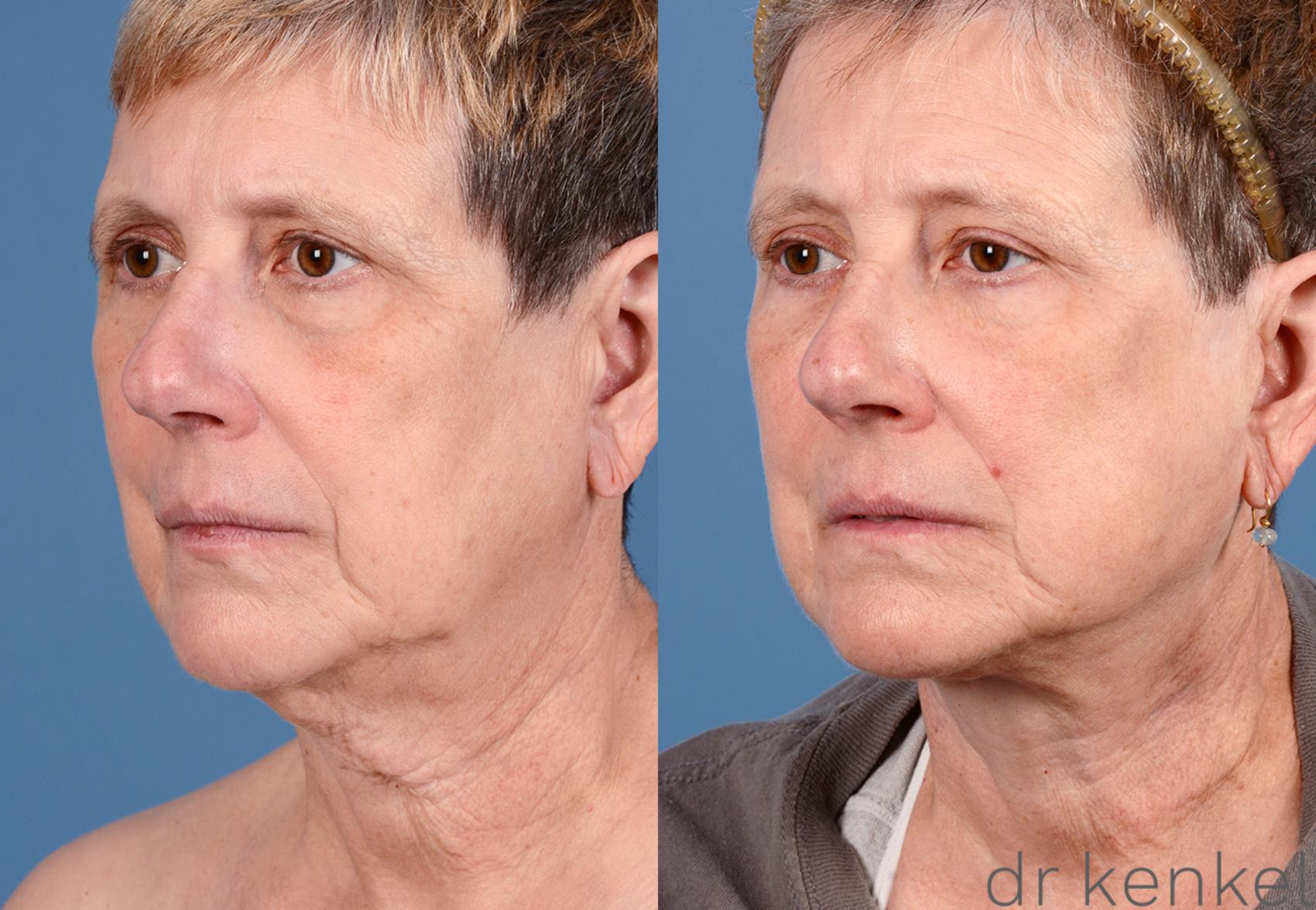 Before & After Brow Lift Case 264 View #1 View in Dallas, Frisco, McKinney, Prosper, Allen, Celina, Denton, Anna, TX