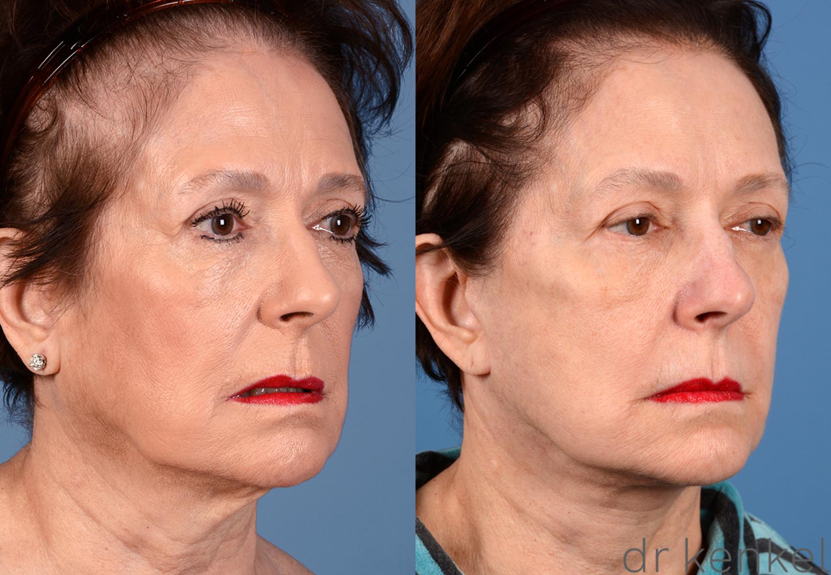 Before & After Eyelid Surgery Case 267 View #2 View in Dallas, TX