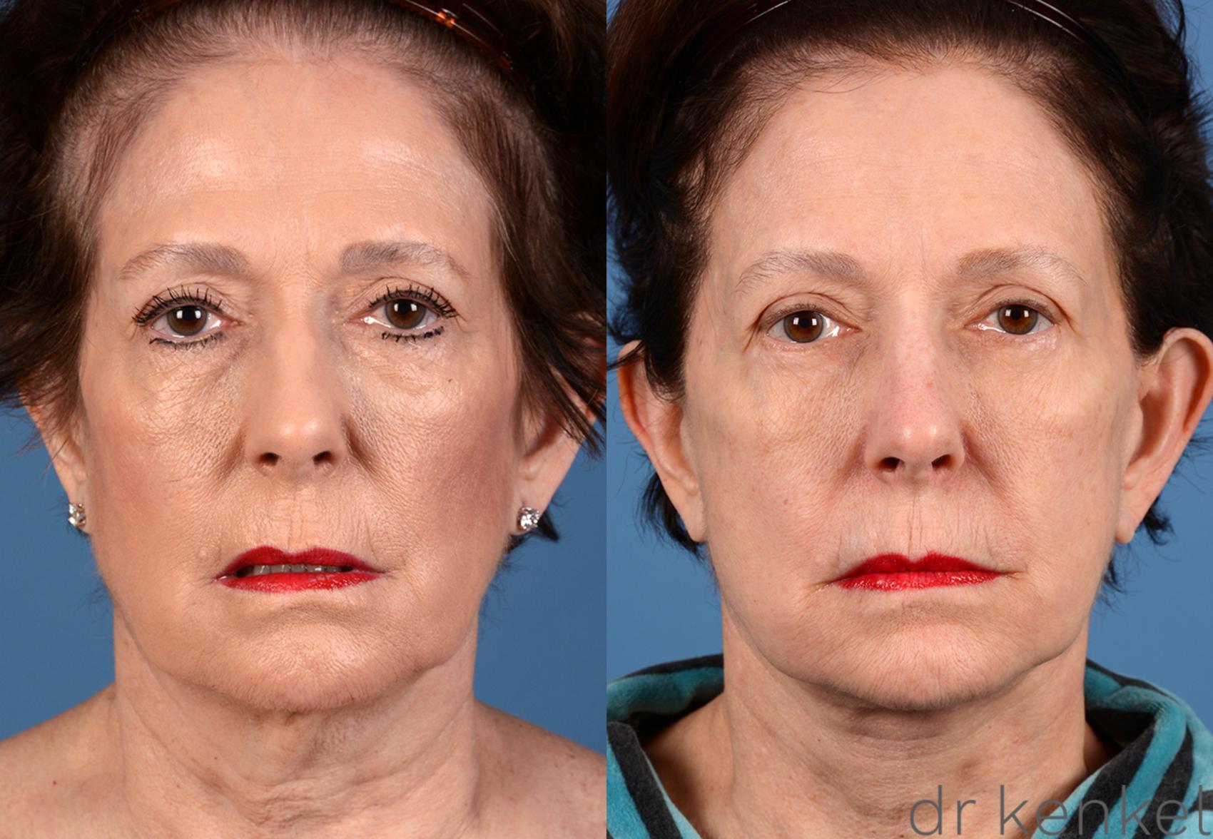 Before & After Eyelid Surgery Case 267 View #3 View in Dallas, TX