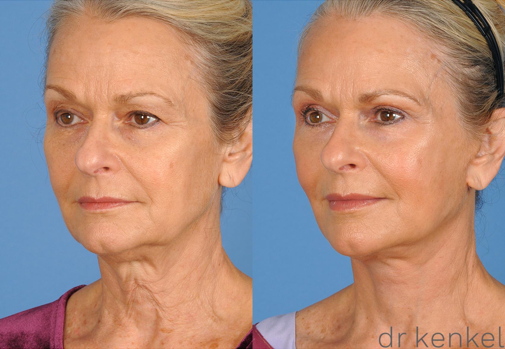 Before & After Neck Lift Case 270 View #1 View in Dallas, TX