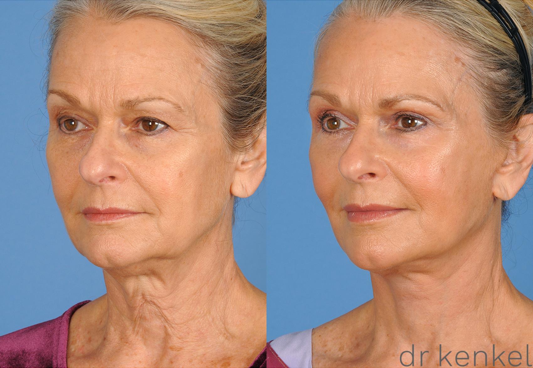 Before & After Neck Lift Case 270 View #1 View in Dallas, Frisco, McKinney, Prosper, Allen, Celina, Denton, Anna, TX