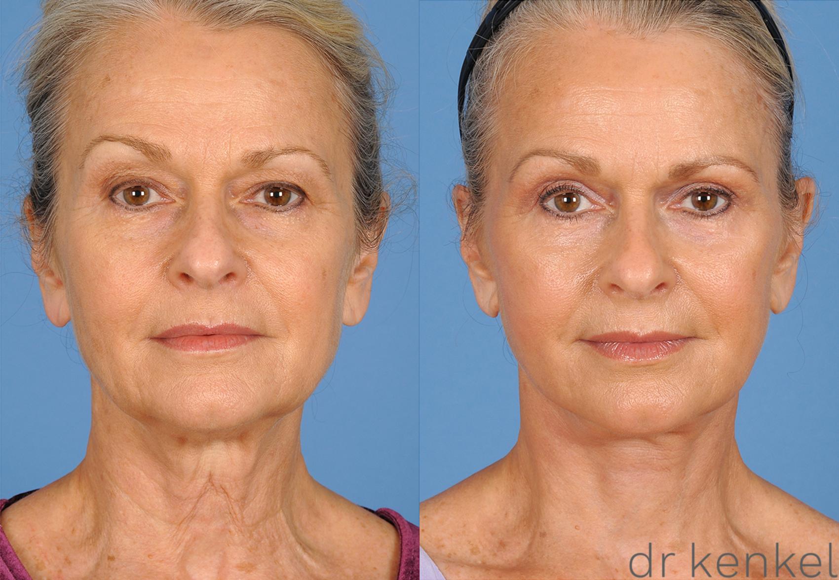 Before & After Neck Lift Case 270 View #2 View in Dallas, TX