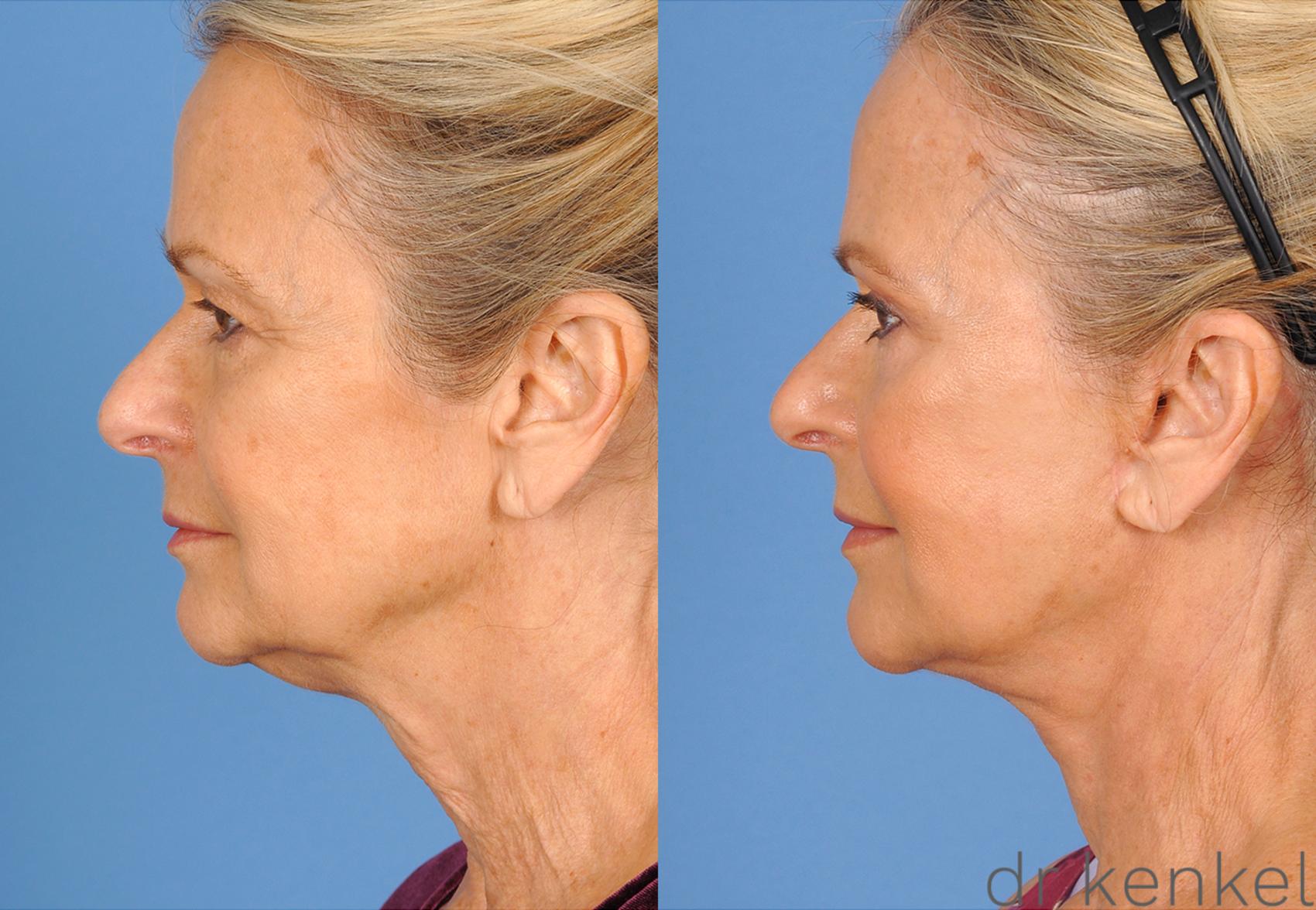 Before & After Neck Lift Case 270 View #3 View in Dallas, TX