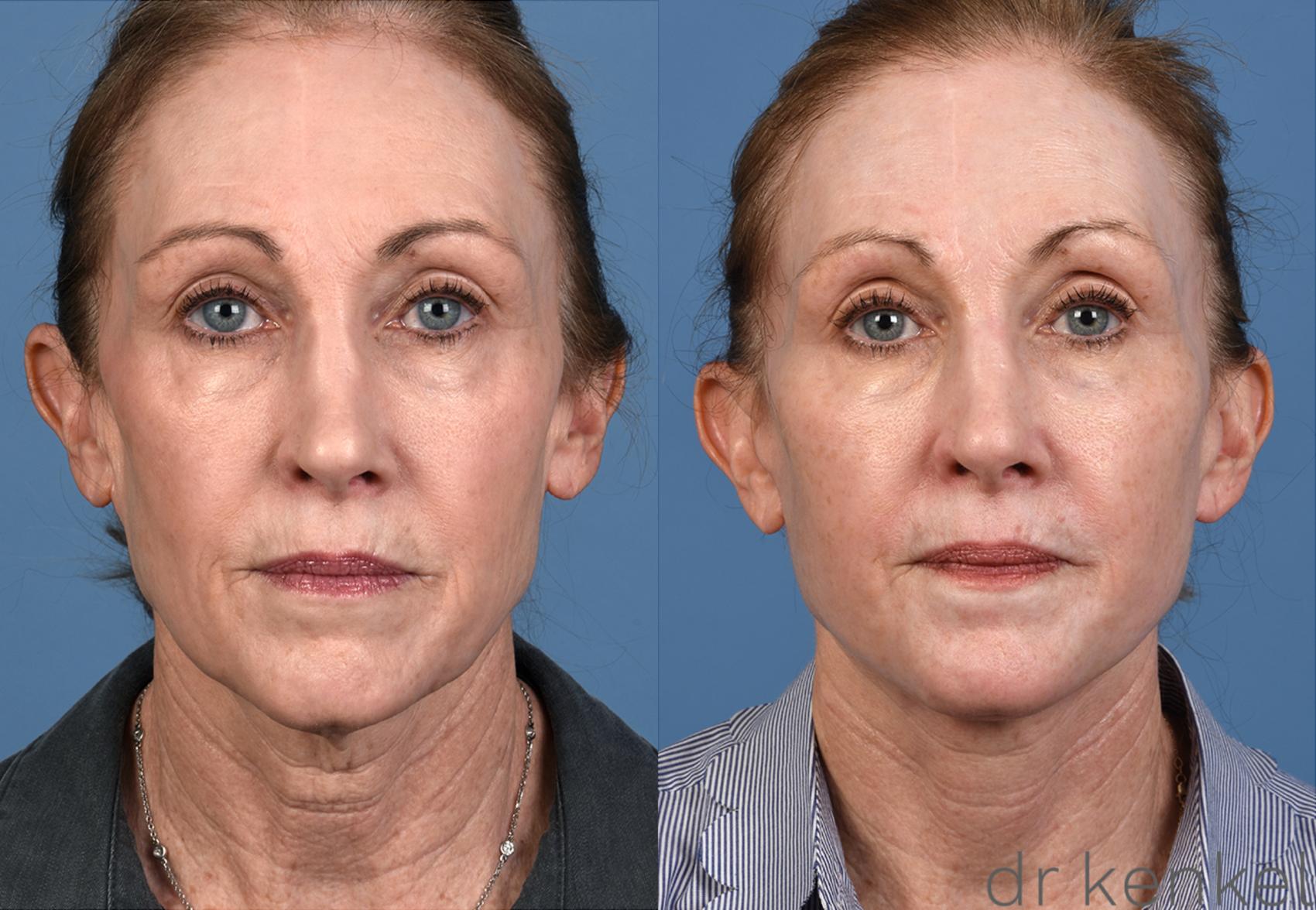 Before & After Facelift Case 306 View #1 View in Dallas, Frisco, McKinney, Prosper, Allen, Celina, Denton, Anna, TX