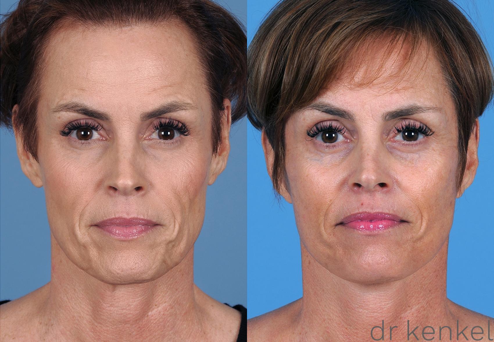 Before & After Facelift Case 314 View #1 View in Dallas, Frisco, McKinney, Prosper, Allen, Celina, Denton, Anna, TX