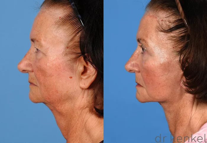 Facelift Before and After Pictures Case 337 | Dallas, Frisco