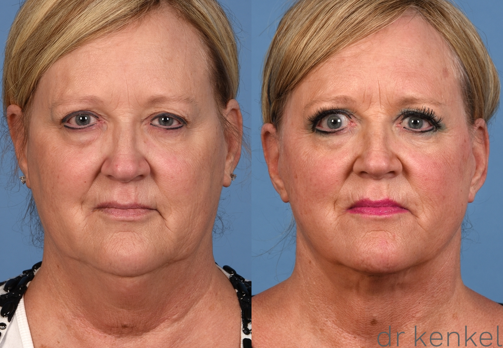 Facelift Before and After Pictures Case 340 | Dallas, Frisco