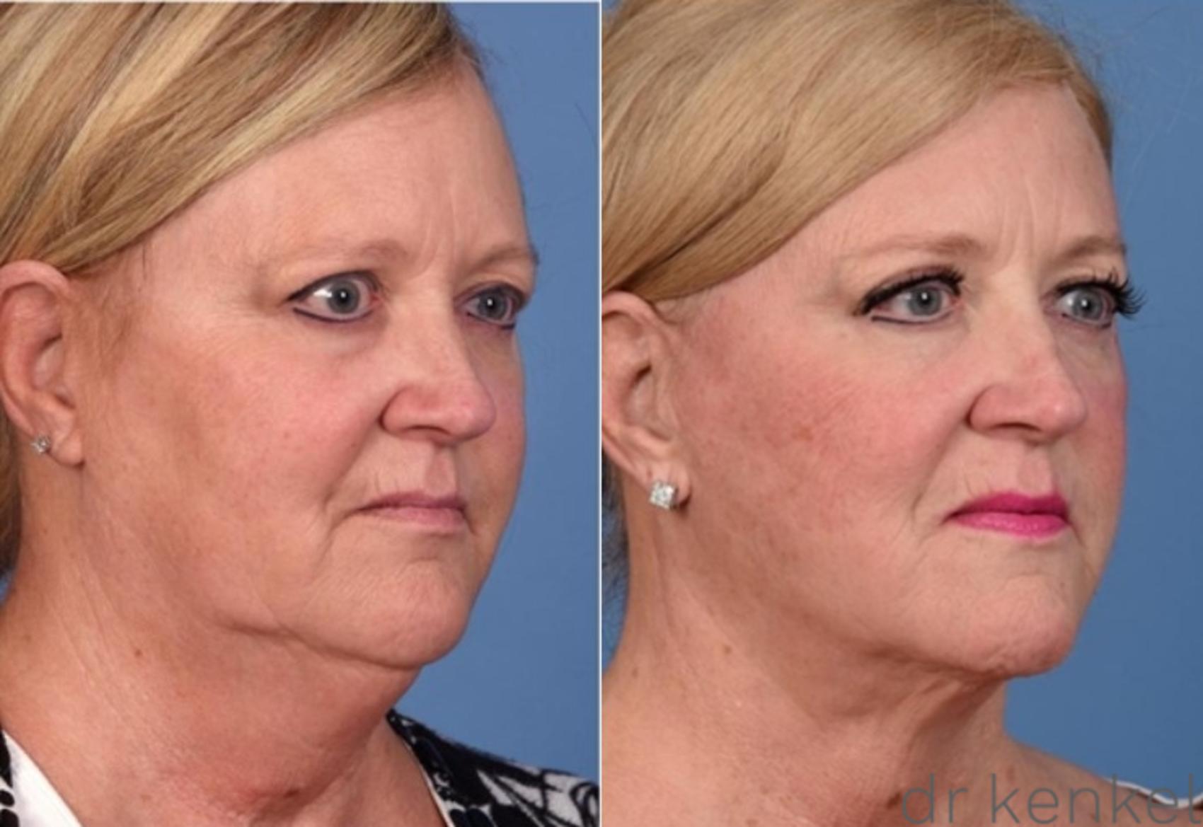 Before & After Facelift Case 340 Right Oblique View in Dallas, Frisco, McKinney, Prosper, Allen, Celina, Denton, Anna, TX