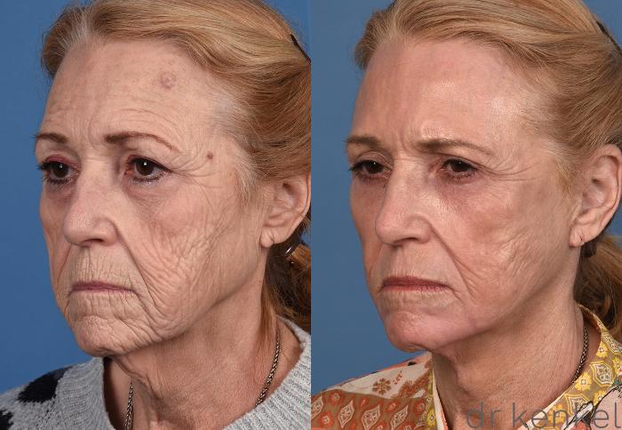 Before & After Facial Rejuvenation Case 346 Left Oblique View in Dallas, Frisco, Fort Worth, McKinney, Prosper, Allen, Celina, Denton, Anna, TX