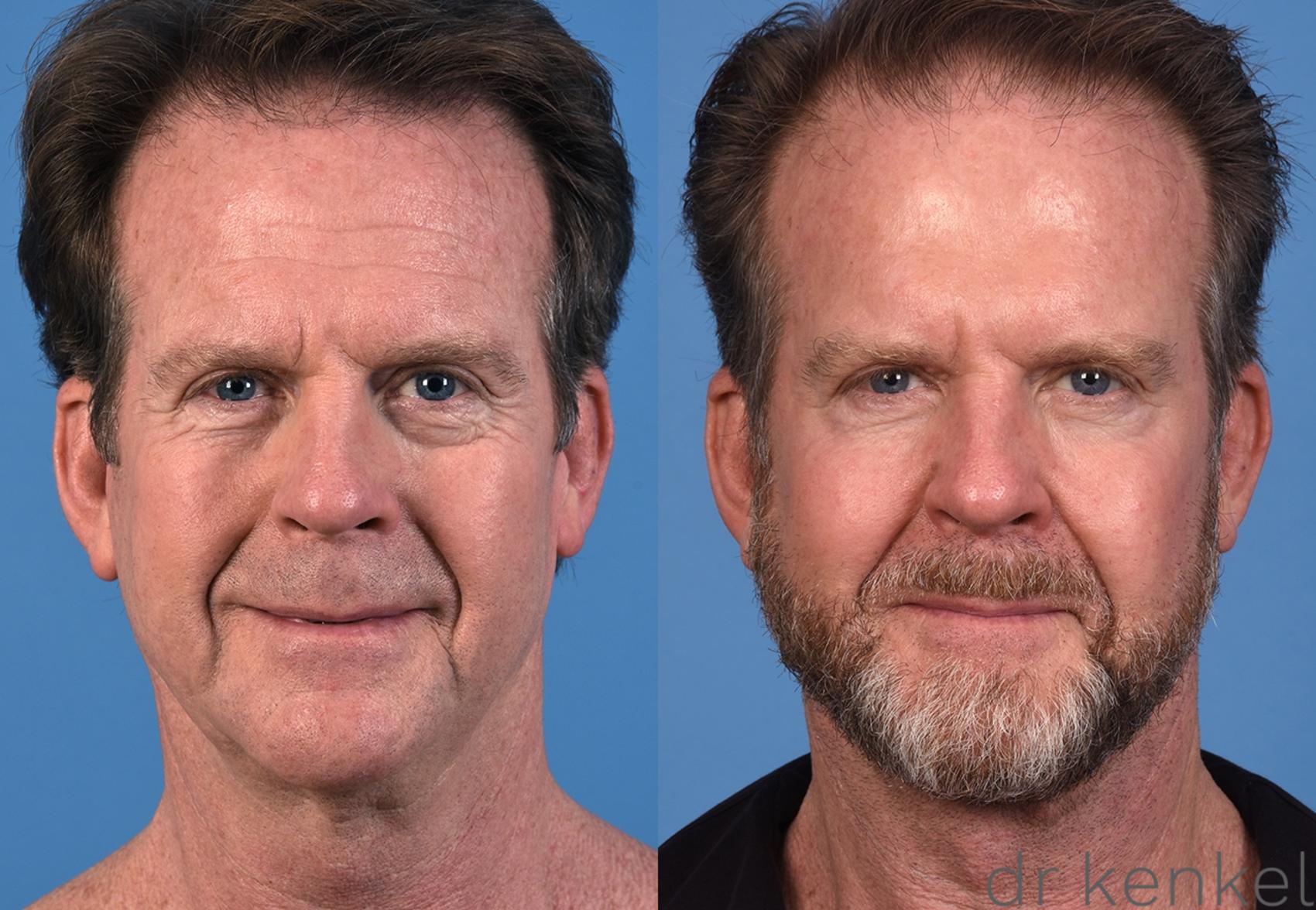 Before & After Facelift Case 351 Front View in Dallas, Frisco, McKinney, Prosper, Allen, Celina, Denton, Anna, TX