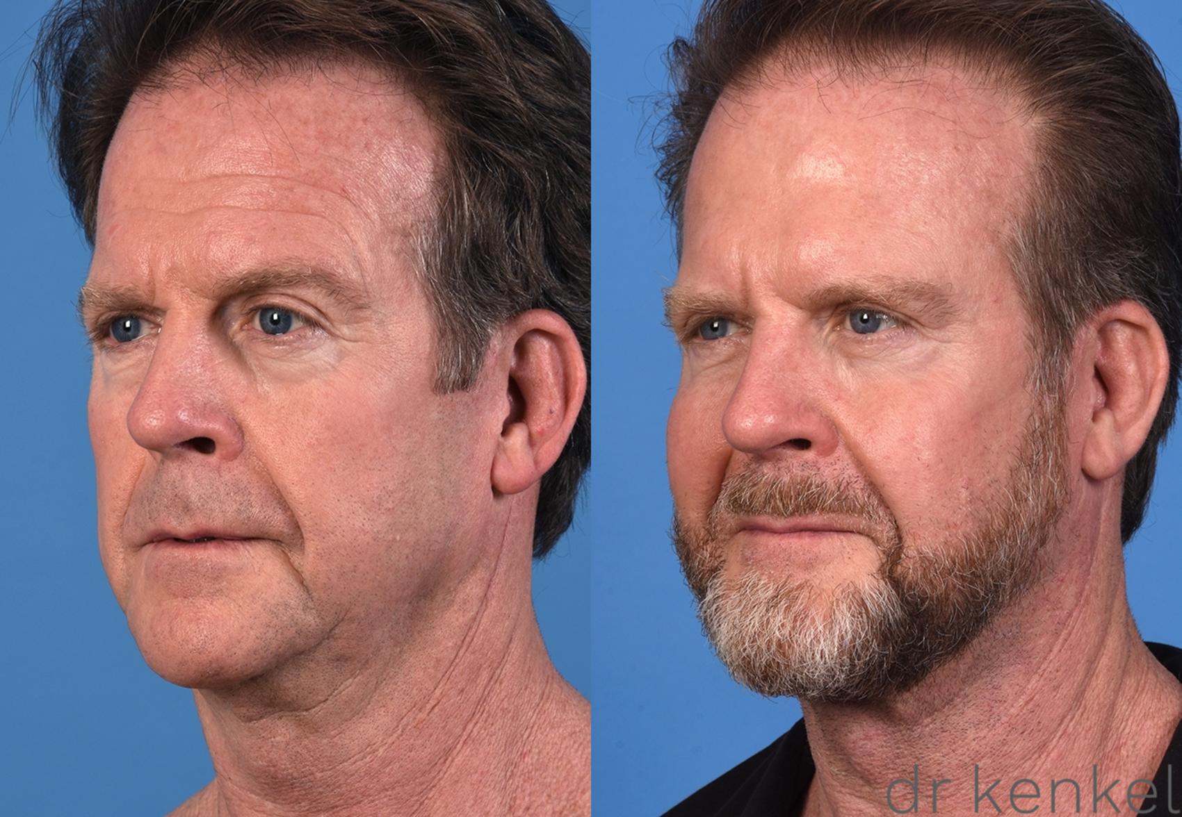 Before & After Facelift Case 351 Right Oblique View in Dallas, Frisco, McKinney, Prosper, Allen, Celina, Denton, Anna, TX