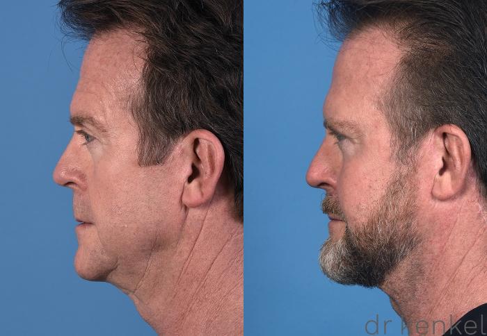 Before & After Facelift Case 351 Right Side View in Dallas, Frisco, McKinney, Prosper, Allen, Celina, Denton, Anna, TX