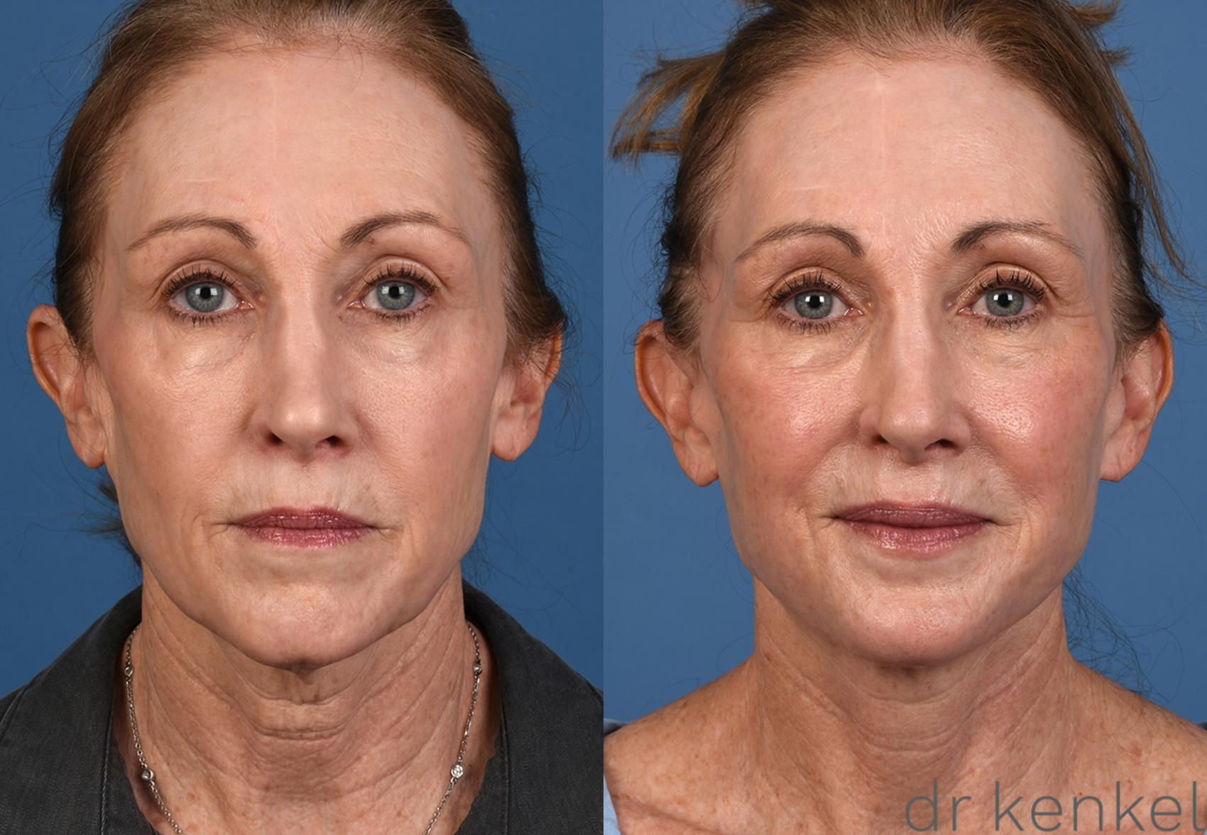 Before & After Facelift Case 352 Front View in Dallas, Frisco, McKinney, Prosper, Allen, Celina, Denton, Anna, TX