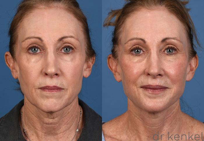 Before & After Facelift Case 352 Front View in Dallas, Frisco, McKinney, Prosper, Allen, Celina, Denton, Anna, TX