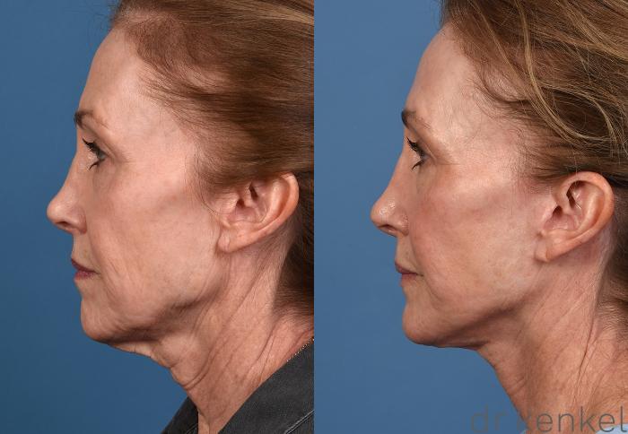 Before & After Facelift Case 352 Left Side View in Dallas, Frisco, McKinney, Prosper, Allen, Celina, Denton, Anna, TX