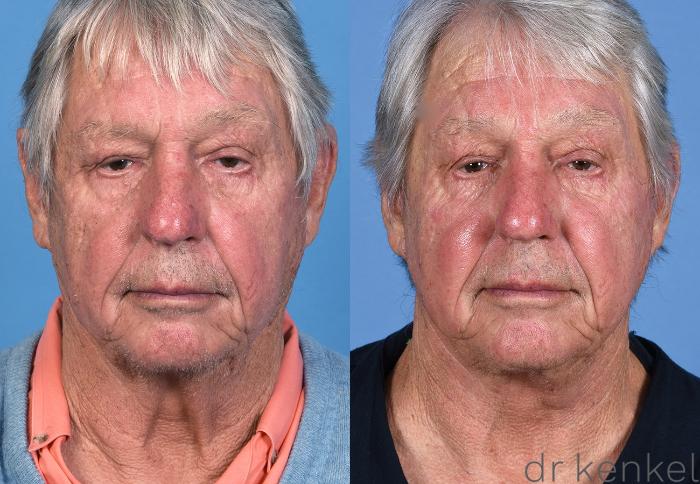 Before & After Facelift Case 355 Front View in Dallas, Frisco, McKinney, Prosper, Allen, Celina, Denton, Anna, TX