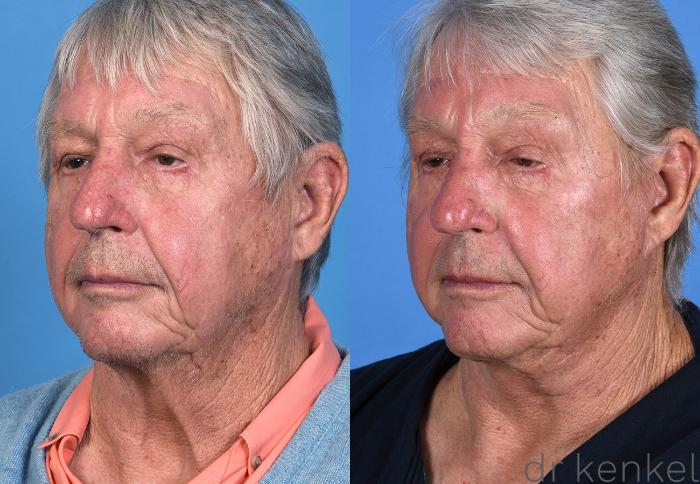 Before & After Facelift Case 355 Left Oblique View in Dallas, Frisco, McKinney, Prosper, Allen, Celina, Denton, Anna, TX
