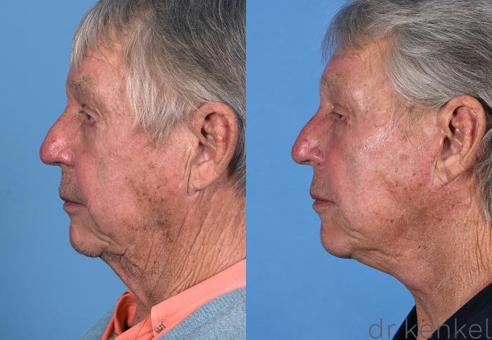Before & After Facelift Case 355 Left Side View in Dallas, Frisco, McKinney, Prosper, Allen, Celina, Denton, Anna, TX