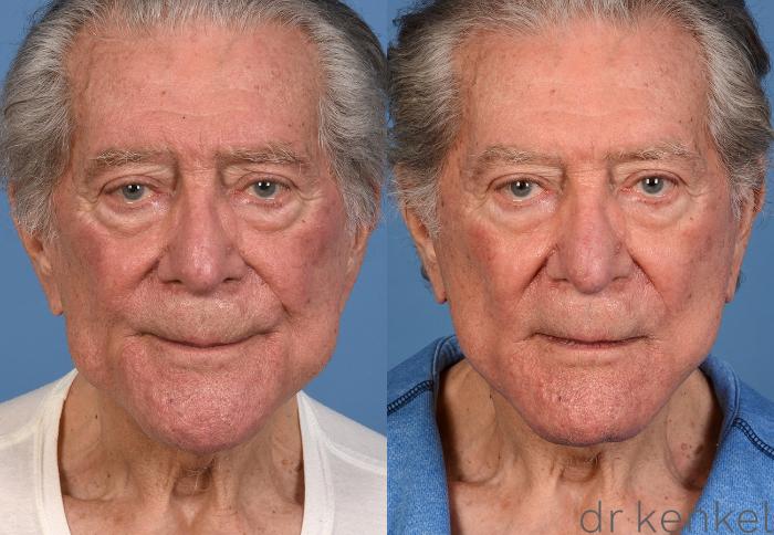 Before & After Facelift Case 356 Front View in Dallas, Frisco, McKinney, Prosper, Allen, Celina, Denton, Anna, TX