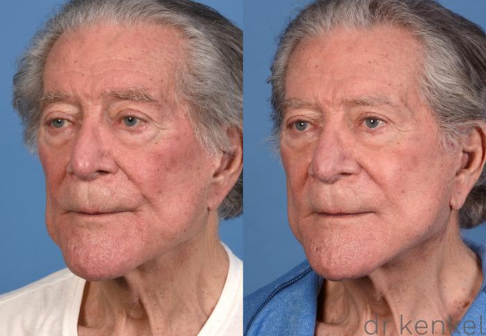 Before & After Facelift Case 356 Left Oblique View in Dallas, Frisco, McKinney, Prosper, Allen, Celina, Denton, Anna, TX
