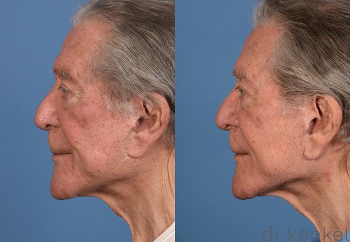 Before & After Facelift Case 356 Left Side View in Dallas, Frisco, McKinney, Prosper, Allen, Celina, Denton, Anna, TX