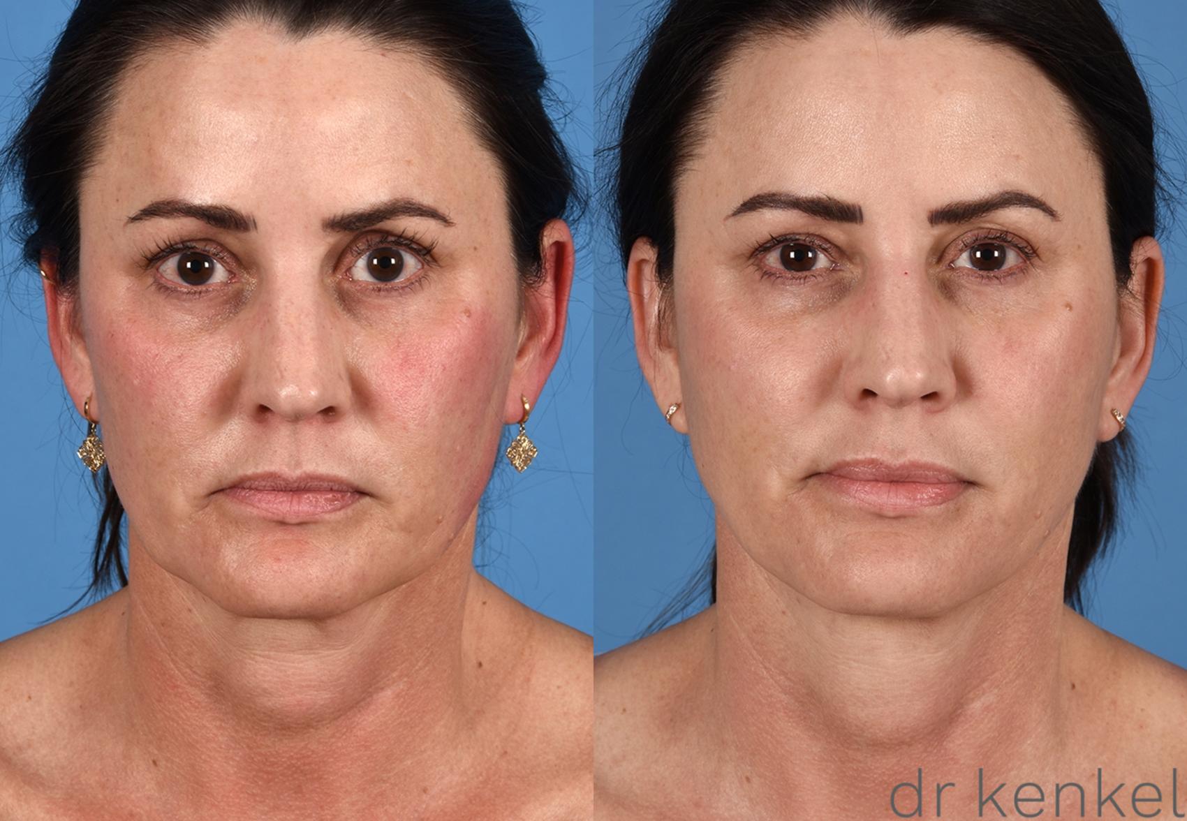 Before & After Facelift Case 358 Front View in Dallas, Frisco, McKinney, Prosper, Allen, Celina, Denton, Anna, TX