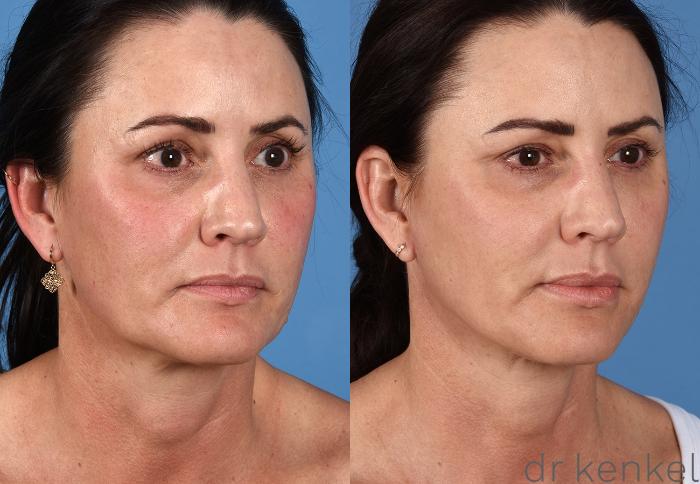 Before & After Facelift Case 358 Right Oblique View in Dallas, Frisco, McKinney, Prosper, Allen, Celina, Denton, Anna, TX