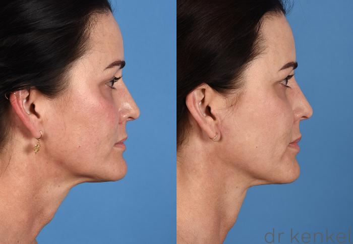 Before & After Facelift Case 358 Right Side View in Dallas, Frisco, McKinney, Prosper, Allen, Celina, Denton, Anna, TX
