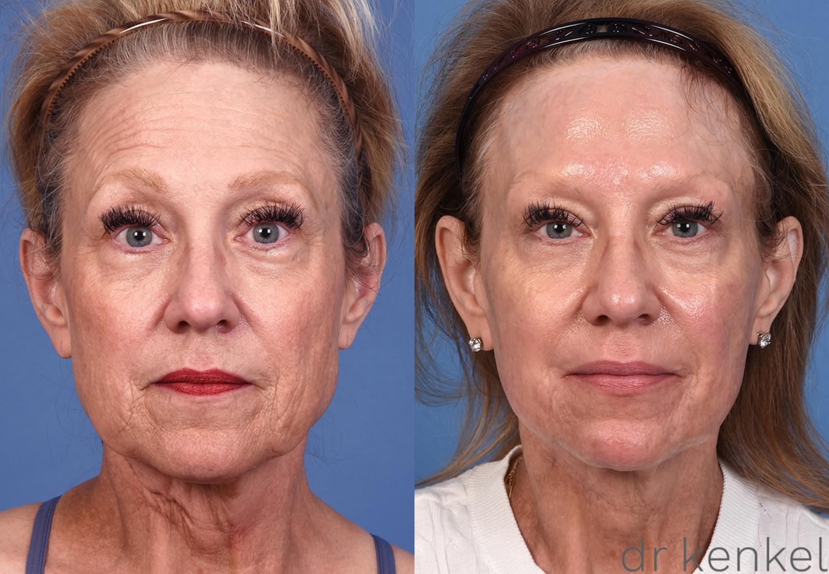 Before & After Brow Lift Case 362 Front View in Dallas, Frisco, McKinney, Prosper, Allen, Celina, Denton, Anna, TX
