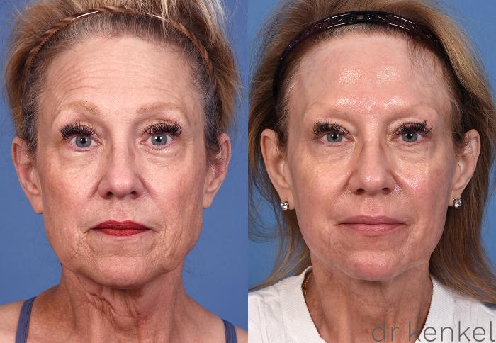 Before & After Brow Lift Case 362 Front View in Dallas, Frisco, McKinney, Prosper, Allen, Celina, Denton, Anna, TX