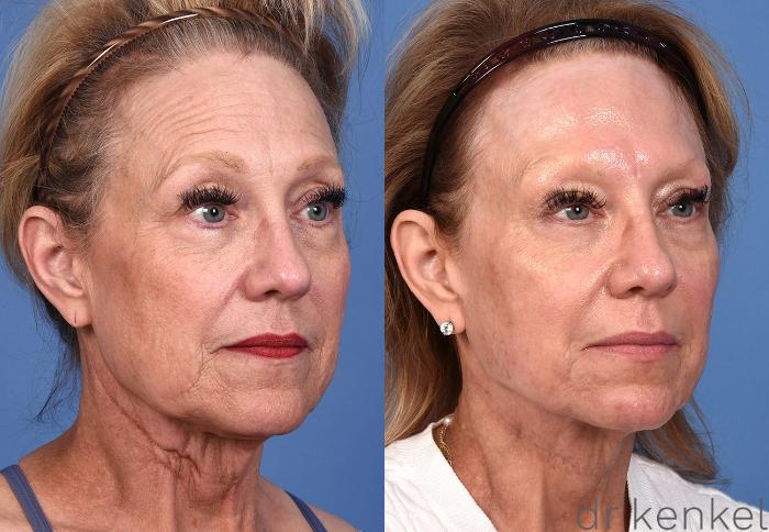 Before & After Brow Lift Case 362 Right Oblique View in Dallas, Frisco, McKinney, Prosper, Allen, Celina, Denton, Anna, TX