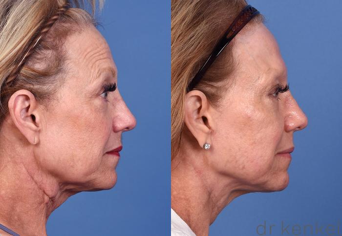 Before & After Brow Lift Case 362 Right Side View in Dallas, Frisco, McKinney, Prosper, Allen, Celina, Denton, Anna, TX