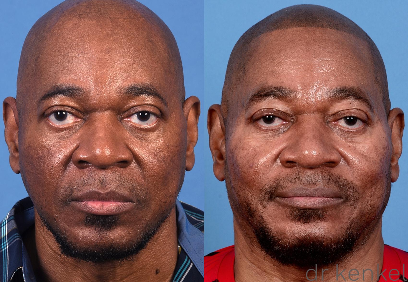 Before & After Eyelid Surgery Case 367 Front View in Dallas, Frisco, McKinney, Prosper, Allen, Celina, Denton, Anna, TX