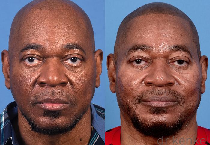 Before & After Eyelid Surgery Case 367 Front View in Dallas, Frisco, McKinney, Prosper, Allen, Celina, Denton, Anna, TX