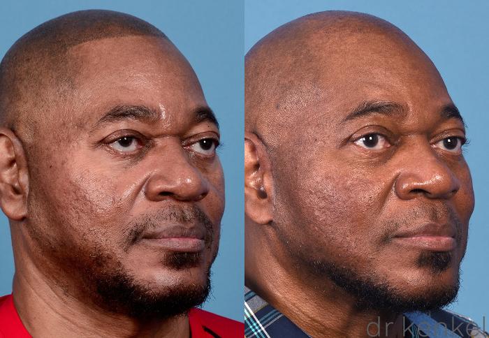 Before & After Eyelid Surgery Case 367 Right Oblique View in Dallas, Frisco, McKinney, Prosper, Allen, Celina, Denton, Anna, TX