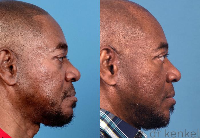 Before & After Eyelid Surgery Case 367 Right Side View in Dallas, Frisco, McKinney, Prosper, Allen, Celina, Denton, Anna, TX