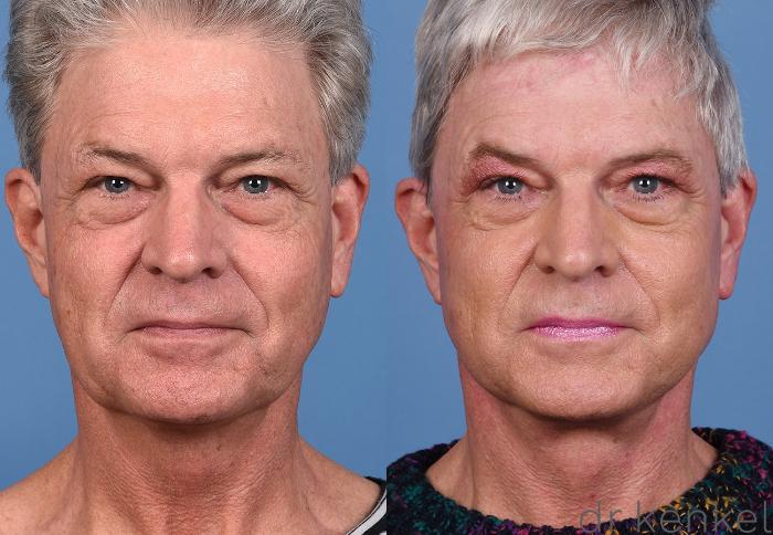 Before & After Facelift Case 369 Front View in Dallas, Frisco, McKinney, Prosper, Allen, Celina, Denton, Anna, TX