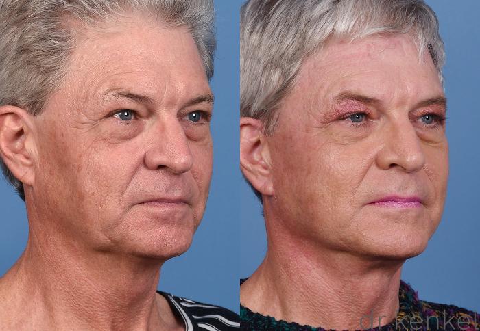 Before & After Facelift Case 369 Right Oblique View in Dallas, Frisco, McKinney, Prosper, Allen, Celina, Denton, Anna, TX