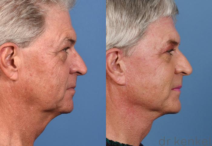 Before & After Facelift Case 369 Right Side View in Dallas, Frisco, McKinney, Prosper, Allen, Celina, Denton, Anna, TX