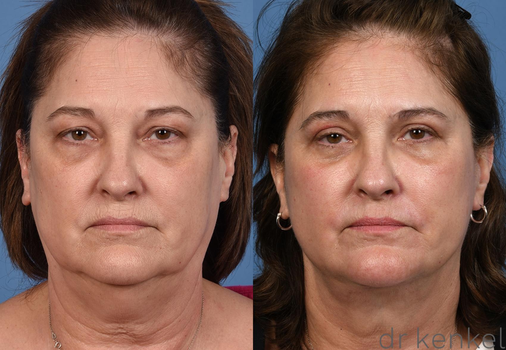 Before & After Eyelid Surgery Case 376 Front View in Dallas, Frisco, McKinney, Prosper, Allen, Celina, Denton, Anna, TX