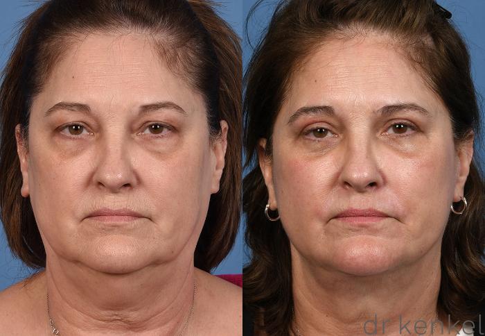 Before & After Eyelid Surgery Case 376 Front View in Dallas, Frisco, McKinney, Prosper, Allen, Celina, Denton, Anna, TX