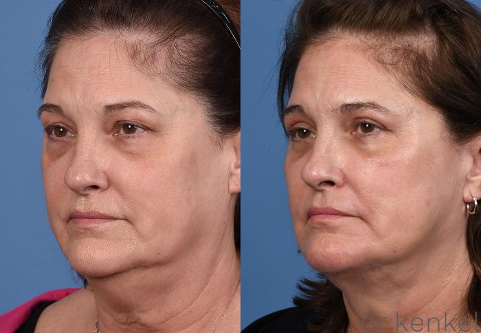 Before & After Eyelid Surgery Case 376 Left Oblique View in Dallas, Frisco, McKinney, Prosper, Allen, Celina, Denton, Anna, TX
