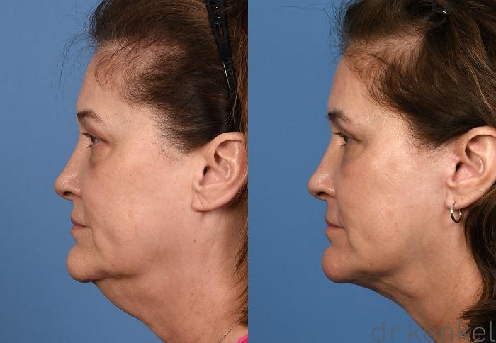 Before & After Eyelid Surgery Case 376 Left Side View in Dallas, Frisco, McKinney, Prosper, Allen, Celina, Denton, Anna, TX